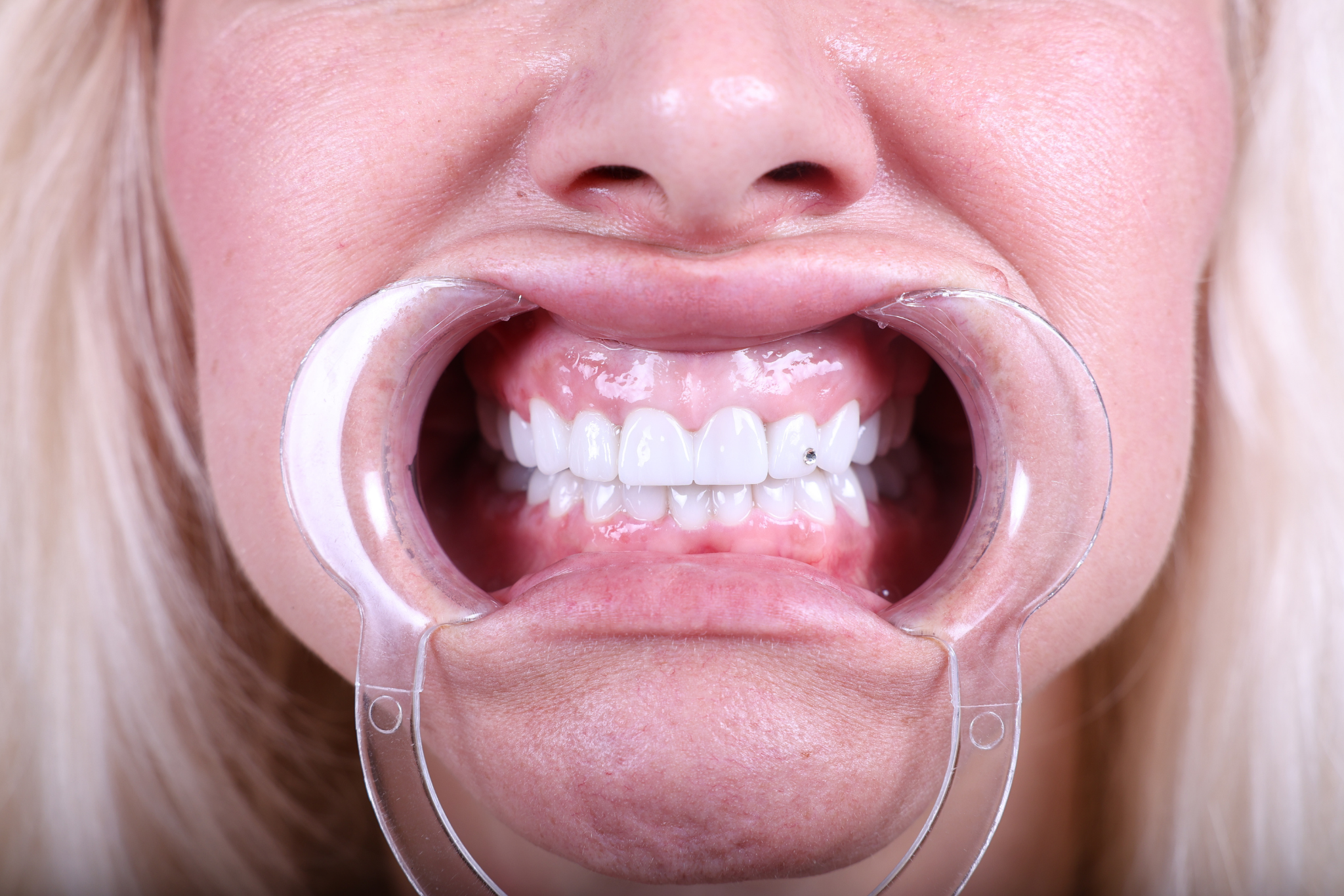 After Zirconia Crown Treatment